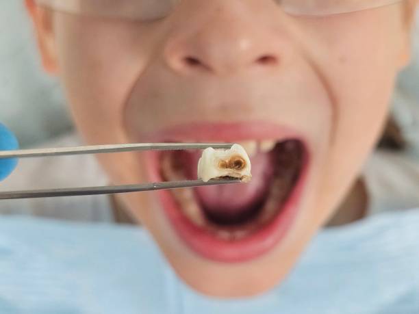 Best Urgent Care for Lost Fillings or Crowns in Kennedy, CA